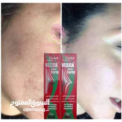  6 كريم فيسكا نيوفورت Vesca newForte لازالة الكلف و النمش و التصبغات الجلدية تركيبة ثلاثية سريعة