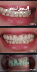  3 زراعة تركيب(تلبيس،وجسور)  اسنان افضل الانواع