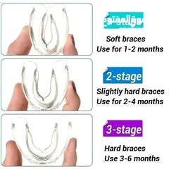  3 تصحيح الاسنان بثلاث مراحل