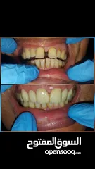  4 زراعة تركيب(تلبيس،وجسور)  اسنان افضل الانواع