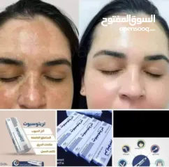  3 كريم #تريتوسبوت الأصلي آمن على البشرة  نكفل لكم النتائج  يستخدم مرهم تريتوسبوت لعلاج الحالات