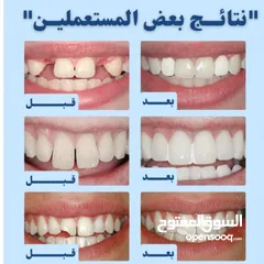  3 حشوه اصلاح الاسنان مؤقته للي يعاني من الالم حفرة داخل الاسنان او اصلاح كسر الاسنان