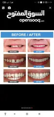  3 ماده قويه لعمل اسنان صناعي