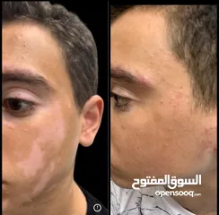  5 البهاق وطرق علاجيه تساعد بتوحيد لون البشره ومعالجة البهاق