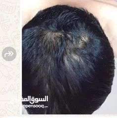  8 minoxidil منتج منع الصلع ونمو الشعر واللحيه