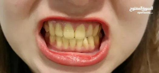  7 بودة تبييض الأسنان