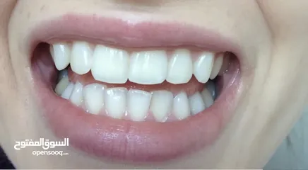  4 عرض خاص (شرائط تبييض الاسنان )