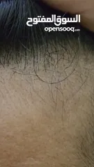  4 علاج تساقط الشعر الوحيد المصرح مينوكسيديل وفيناسترايد