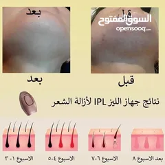  2 جهاز ليزر لزاله شعر