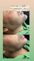  15 خدمات تجميل(حقن)