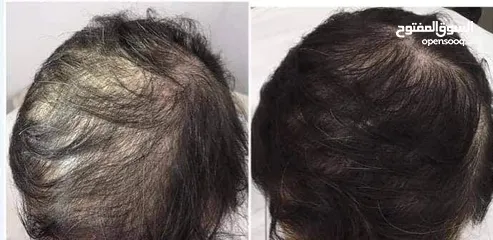  3 هام للرجال والنساء ودع تساقط الشعر الفراغات الصلع الوراثي بديل زراعة الشعر