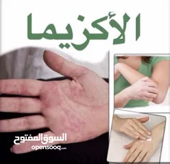  1 خلطة للتحلص من الاكزيما