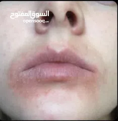  3 خلطة للتحلص من الاكزيما