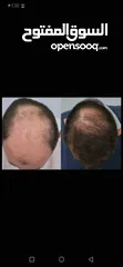  5 هام للرجال والنساء ودع تساقط الشعر الفراغات الصلع الوراثي بديل زراعة الشعر