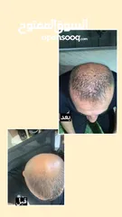  7 هام للرجال والنساء ودع تساقط الشعر الفراغات الصلع الوراثي بديل زراعة الشعر