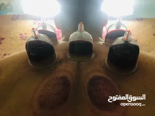  3 الحجامه الاسلاميه  Islamic cupping