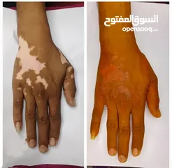  4 البهاق وطرق علاجيه تساعد بتوحيد لون البشره ومعالجة البهاق