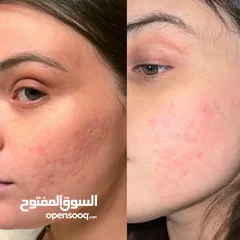  5 جلسة علاج بشرة