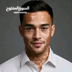  7 البهاق وطرق علاجيه تساعد بتوحيد لون البشره ومعالجة البهاق