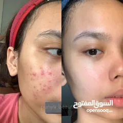  6 حب الشباب  ، عناية بالبشرة  Skincare , acne