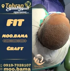  2 زراعة الشعر الطبيعي في ايران طهران