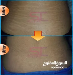  4 Stretch marks solution