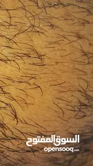  8 علاج تساقط الشعر الوحيد المصرح مينوكسيديل وفيناسترايد