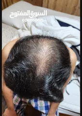  21 سيروم لعلاج تساقط الشعر ممتاز والنتائج خلال 4 اسابيع فقط