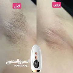  14 ليزر DEESS لازالة الشعر