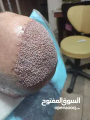  19 زراعة الشعر الطبيعي في ايران طهران