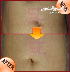  1 Stretch marks solution