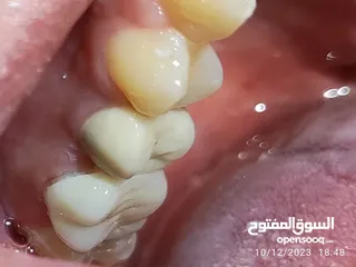  17 علاج اسنان مدينة الرياض