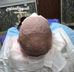  23 زراعة الشعر الطبيعي في ايران طهران