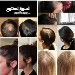  5 زيت الساسو الهندي لنمو الشعر و تعبئة الفراغات و معالجة الثعلبة و زيادة كثافة الشعر
