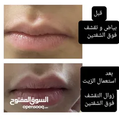  4 كريم الاكزيما و حب الشباب Eczema and Acne