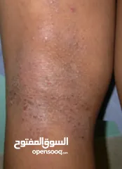  4 خلطة للتحلص من الاكزيما