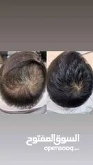  16 هام للرجال والنساء ودع تساقط الشعر الفراغات الصلع الوراثي بديل زراعة الشعر