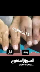  6 البهاق وطرق علاجيه تساعد بتوحيد لون البشره ومعالجة البهاق