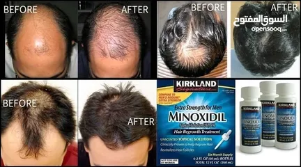  1 minoxidil منتج منع الصلع ونمو الشعر واللحيه