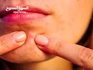  6 حجر المرتك العلاج الفعال لاثار الحبوب والجدري والعنقز والقروح فوائده كثيره انظر الوصف