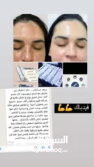  4 كريم #تريتوسبوت الأصلي آمن على البشرة  نكفل لكم النتائج  يستخدم مرهم تريتوسبوت لعلاج الحالات