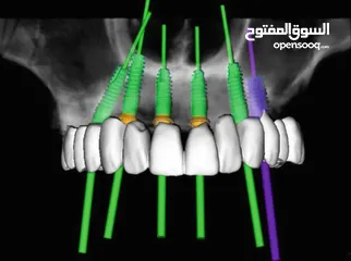  3 زراعة الاسنان الرقمية ( بدون جراحة بدون الم )