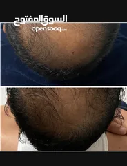  24 سيروم لعلاج تساقط الشعر ممتاز والنتائج خلال 4 اسابيع فقط
