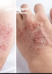  2 خلطة للتحلص من الاكزيما