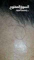  6 علاج تساقط الشعر الوحيد المصرح مينوكسيديل وفيناسترايد