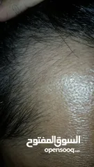  2 علاج تساقط الشعر الوحيد المصرح مينوكسيديل وفيناسترايد
