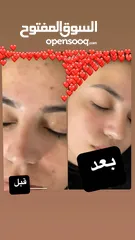  1 جلسة علاج بشرة