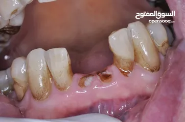  6 خدمات  طب اسنان مجانية وممتازة