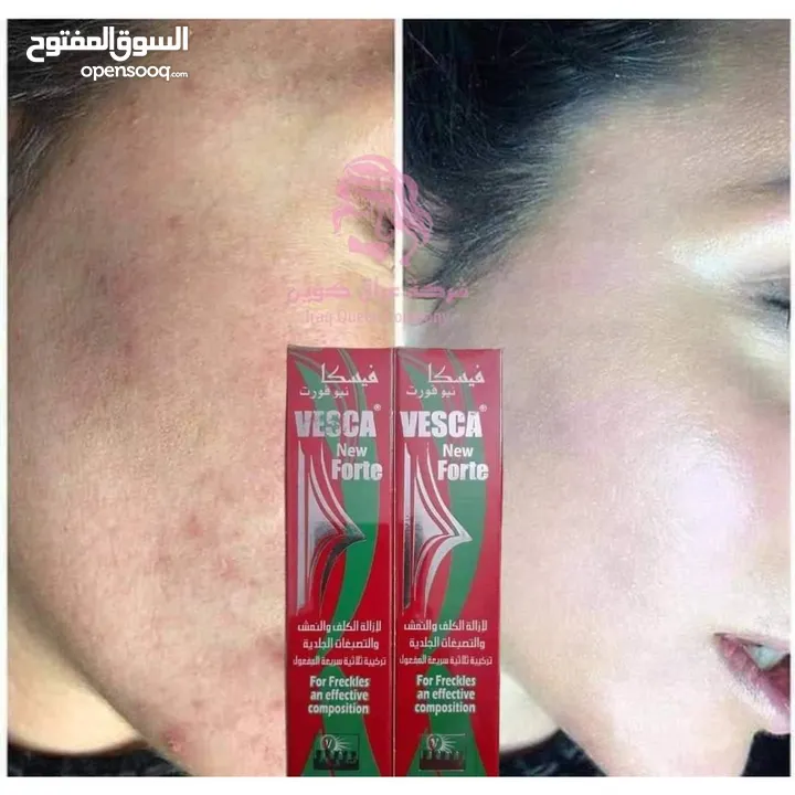 كريم فيسكا نيوفورت Vesca newForte لازالة الكلف و النمش و التصبغات الجلدية تركيبة ثلاثية سريعة