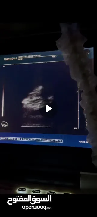 فحص الحمل بالسونار (الأشعة التلفزيونية)